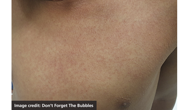 Scarlet Fever rash photo, photo credit Don't forget the bubbles 